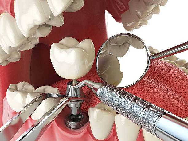 Best Emergency Treatment for Dental Infections or Abscesses in Krugerville, TX